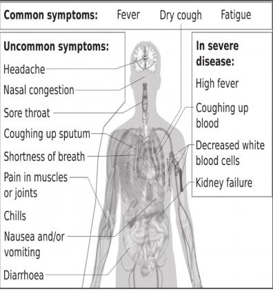 The CDC warned the public on symptoms of the COVID-19. Anybody experiencing these symptoms should consult a physician. Courtesy photo