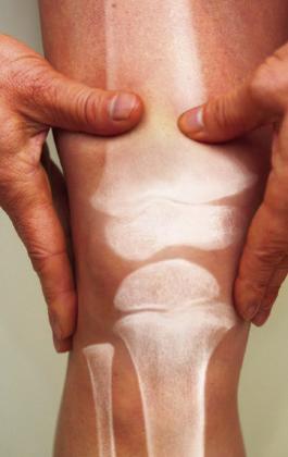 Know your osteoporosis risk