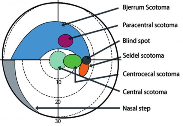 The global impact of glaucoma is significant. The World Health Organization estimates that 4.5 million people are blind due to glaucoma. The diagram above shows the different levels of scotomas. Courtesy photo
